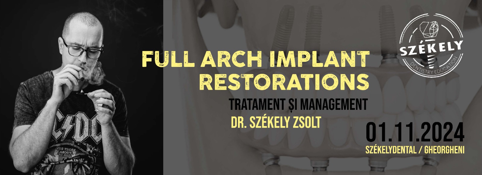 Full Arch Implants Restorations Full Arch Implants Restorations